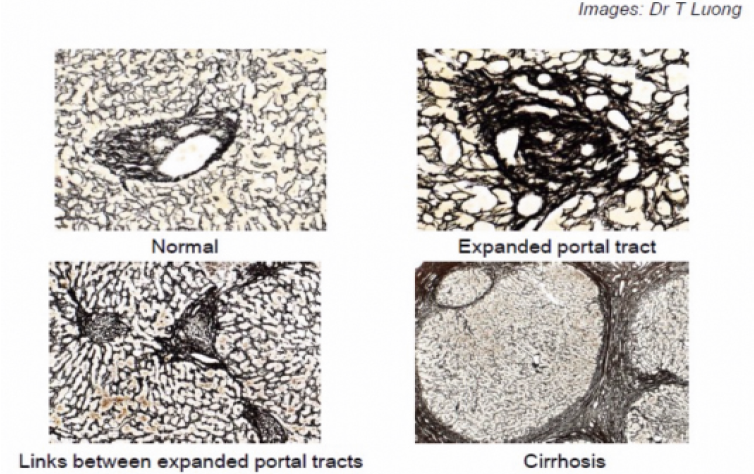 Series of four images showing a normal liver, a liver showing signs of inflamation, a liver with expanding areas of fibrosis and a liver with cirrhosis 